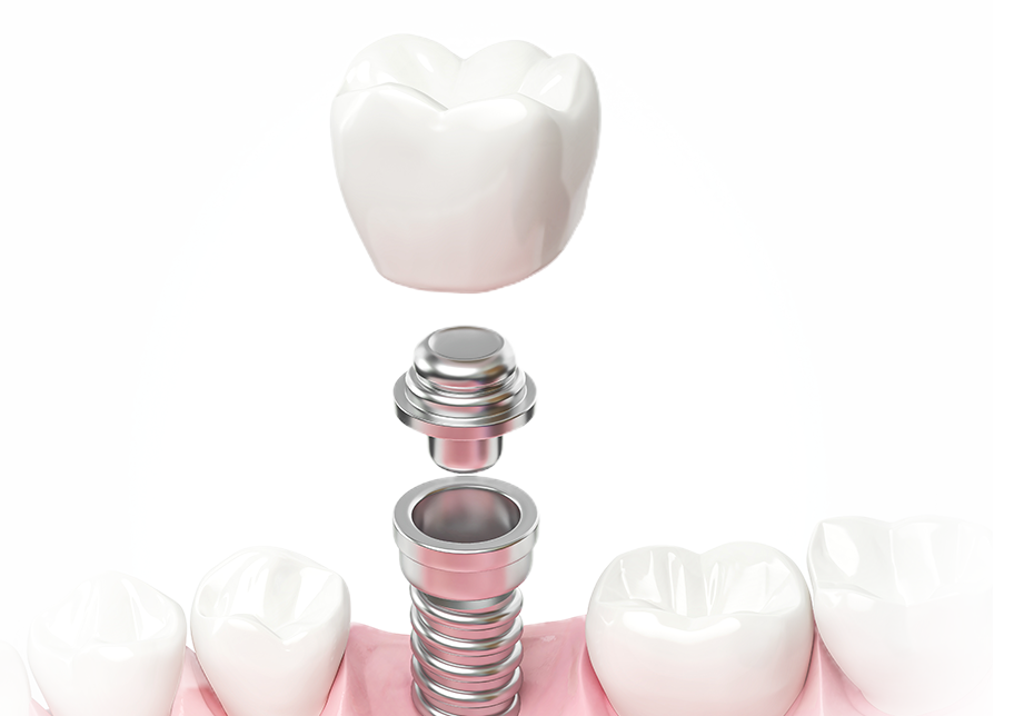 DS Japan Implant System
